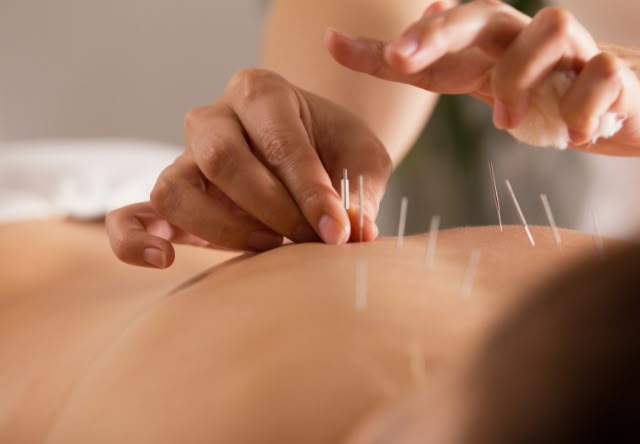 Acupuncture